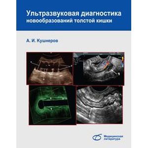 Ультразв. диагностика новообразований толстой кишк